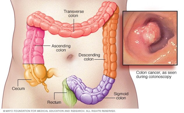 ds00035_im01666_colon_gif ماذا يزيد خطر سرطان القولون؟